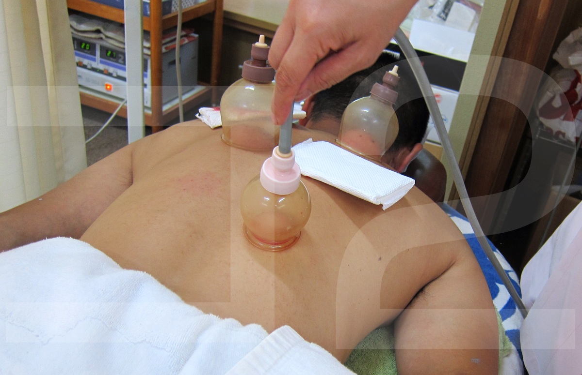 熱を冷やす治療の一例：吸玉を使った刺絡療法